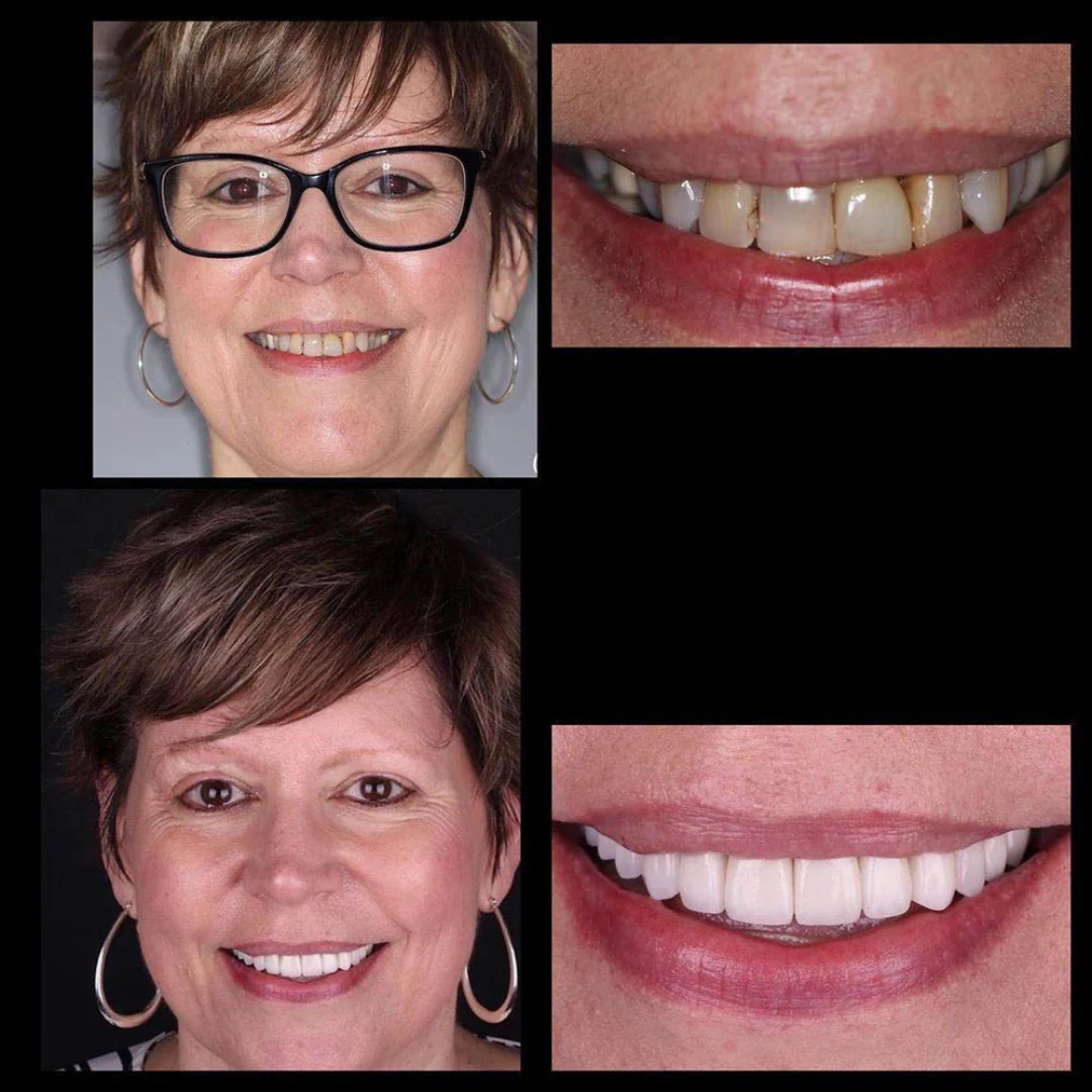 Premium Zahnaufhellungsset