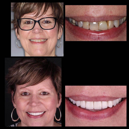 Premium Zahnaufhellungsset